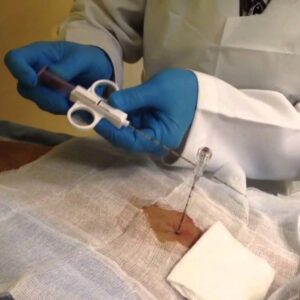 Biopsy needles G.14/16/18